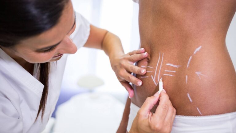 liposuction surgery procedure in Idukki