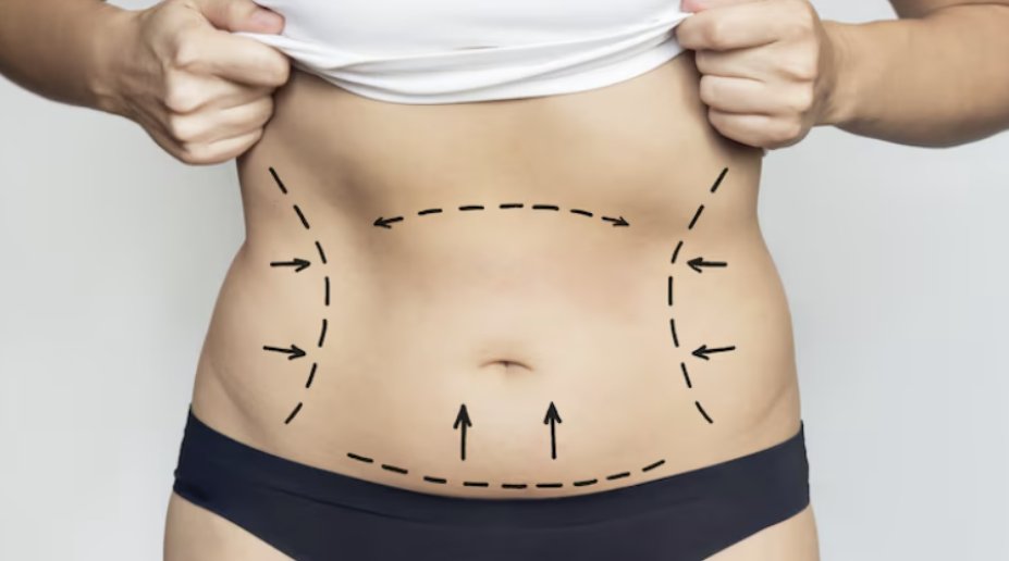 liposuction consultation evaluation in Idukki