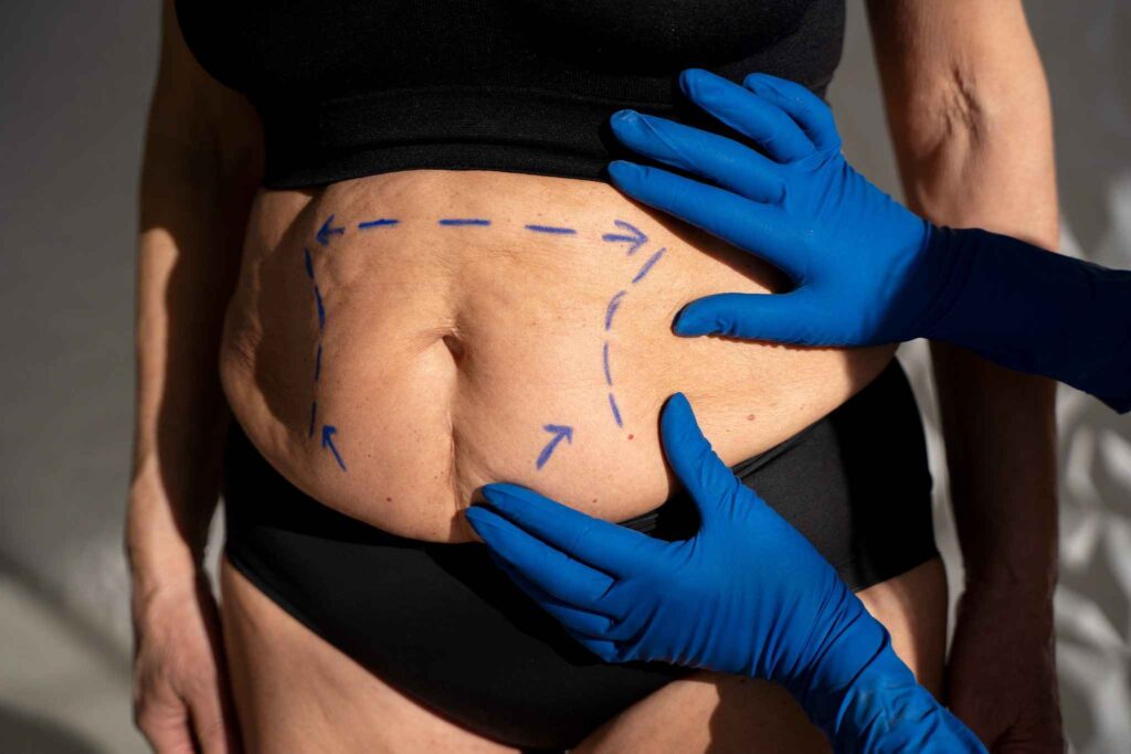 Close-up of a woman holding excess abdominal fat around the stomach, showing localized belly fat.