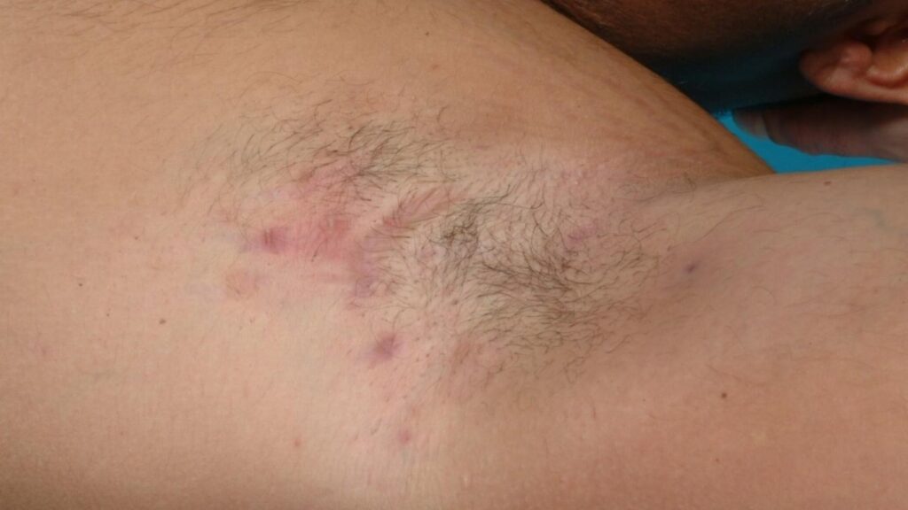 Hidradenitis Treatment Risks in Thodupuzha Idukki