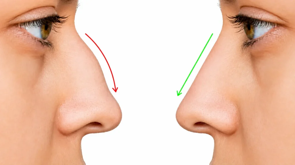 Rhinoplasty surgery in Thodupuzha showing nose reshaping comparison and cosmetic nose contour improvement