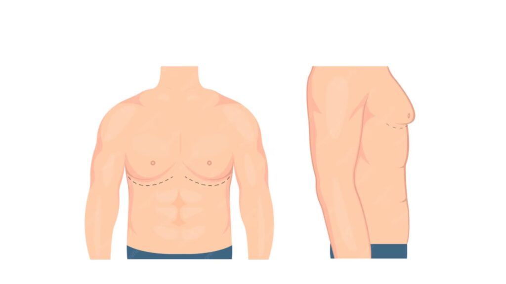 Gynecomastia Surgery in Idukki illustration showing male chest contour with marked surgical areas for treatment planning